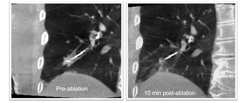 Pulmón antes de ser tratado por cáncer de pulmón y Pulmón después de ser tratado por cáncer de pulmón